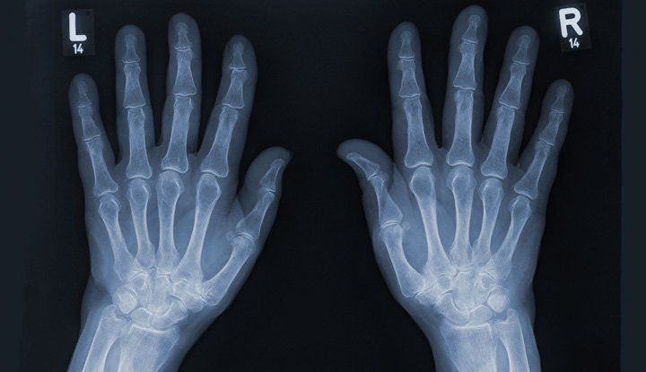 23518 Hand X Ray